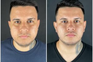 Procedimentos minimamente invasivos para emagrecimento do rosto viram os queridinhos do momento 3 DDFFBDE7 038F 4086 BB3E 0218CF44C622